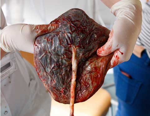 placenta - moderkage efter fødslen 