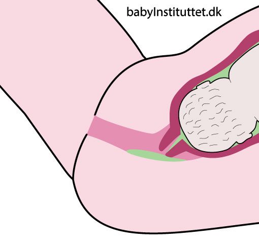 Der er hul på fosterhinderne og grønt forstervand løber ud
