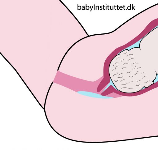 Vandafgang; fostervand der løber ud af skeden forbi barnet hoved