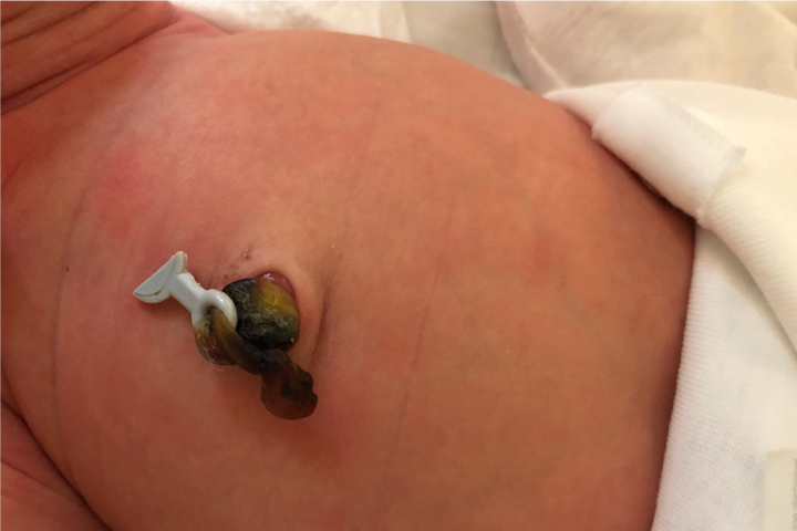 Navlestump med ny type elastik
