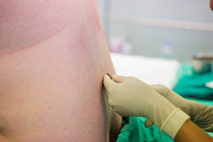 Blood patch efter epidural