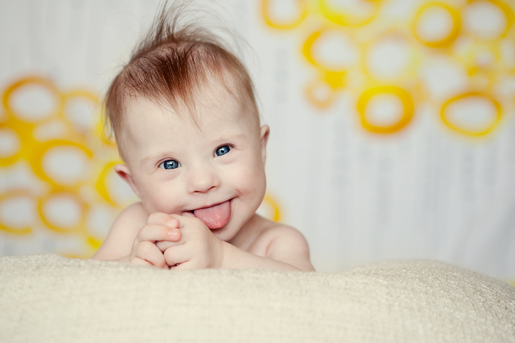 baby med Downs syndrom