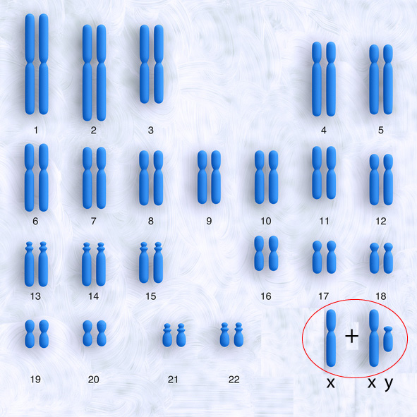 Klinefelters syndrom, 47XXY