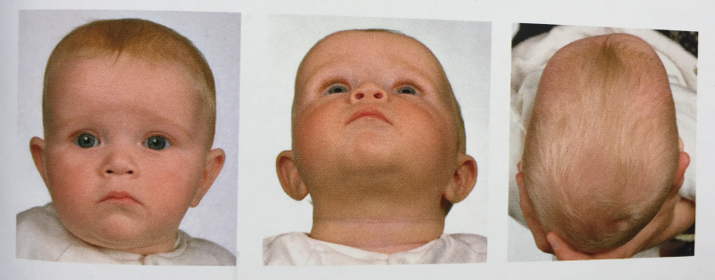 fladt baghoved hos baby