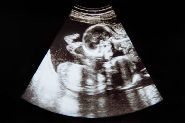 ultralydsscanning af tvillinger